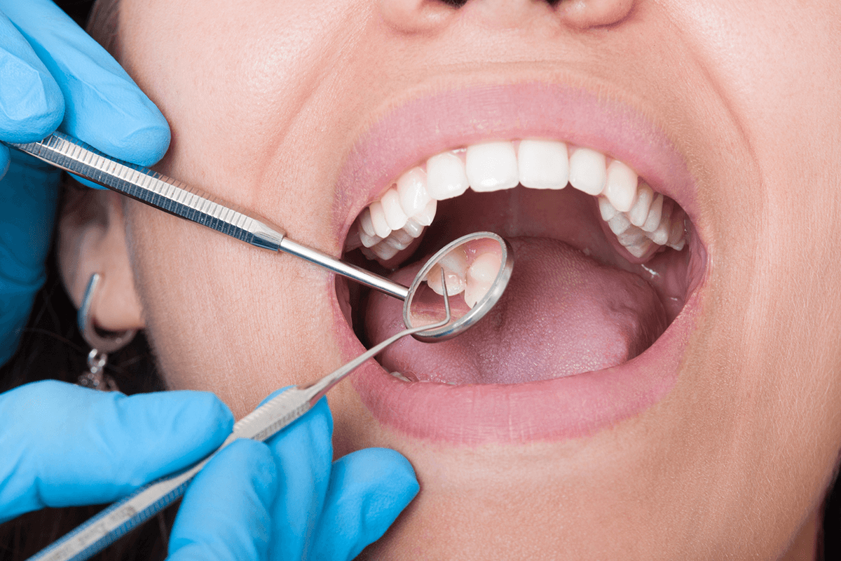 how-often-should-you-get-your-teeth-cleaned