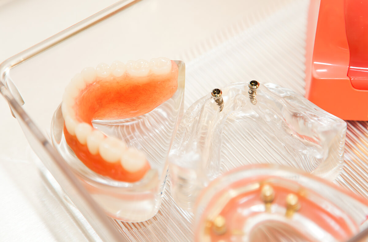 examples of dentures and dental implants in clear tray